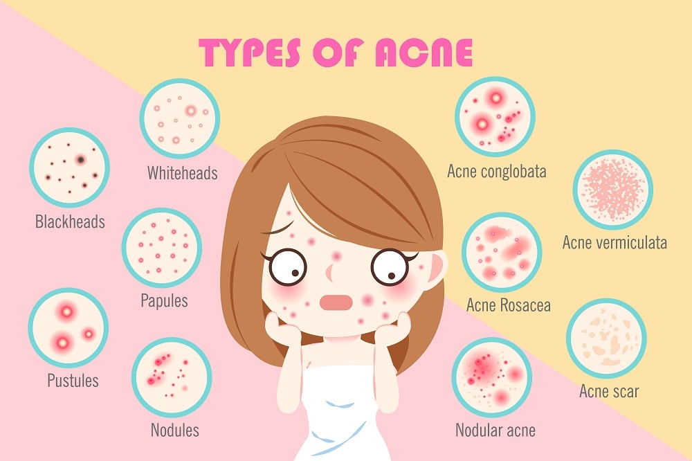 Lactoferrin and Its Effect on Acne