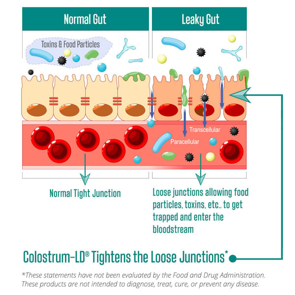 Infografía de intestino normal vs intestino permeable