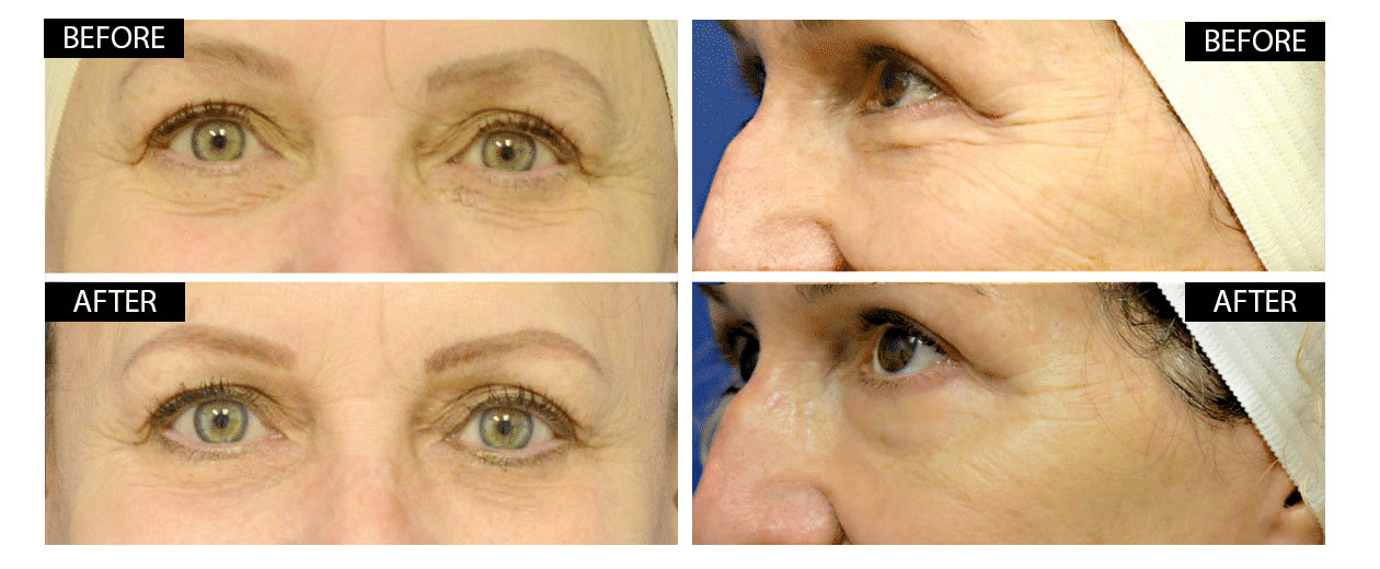 Before and After using Regenacol™